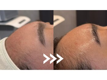 ミトノウ(MITONOU)/エアセラム ビフォーアフター