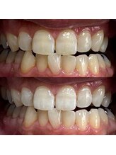 グレイスホワイトニング ヨコハマ(Grace Whitening Yokohama)/30分照射