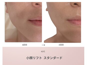 リアン(Lien)/40代 ビフォーアフター