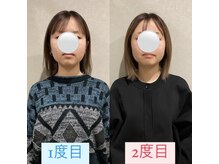 ナオル整体 宮崎院(NAORU整体)/20代女性施術事例【小顔矯正】