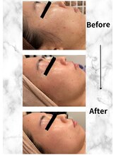 ミエル(Miel)/Before After