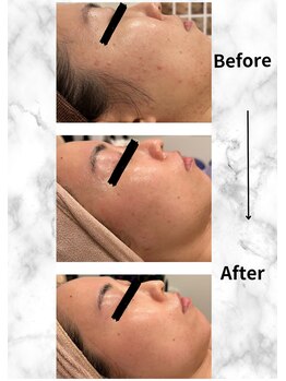 ミエル(Miel)/Before After