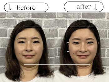 ビースタイル(B-style)/【美容鍼灸】ビフォーアフター