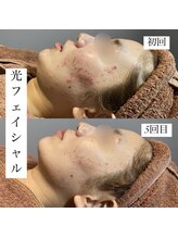 アース コアフュールボーテ 新潟紫竹山店(EARTH coiffure beaute)/光フェイシャル