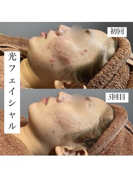 アース コアフュールボーテ 新潟紫竹山店(EARTH coiffure beaute)/光フェイシャル