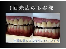 エランホワイトニング 一社店/症例写真