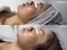 ナチュールムーン(Nature moon.)/ハーブピーリング