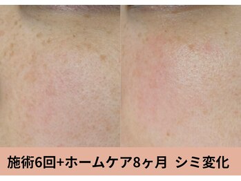 マインドール/シミ集中ケアで頬のシミ変化