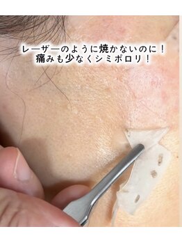 ウィズサロン(withサロン)の写真/年齢とともに悩みになるシミケアに！AI肌診断付ポロリシミケア/3名限定のお得なクーポン