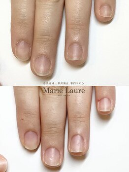 マリーロール 梅田店(Marie Laure)/自爪育成/深爪矯正/ネイルケア