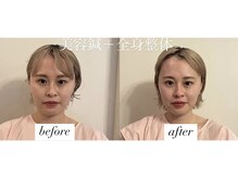 ヤマモト 表参道院(YAMAMOTO)/美容鍼＋全身整体