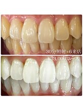 ホワイトニングルーム 横浜店(Whitening Room)/ホワイトニング/横浜