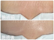 カピリナ(ka pilina)/おでこの毛穴もスッキリ洗浄