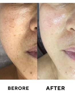 ゼロ(ZERO)/シミシワ肌質改善スペシャル