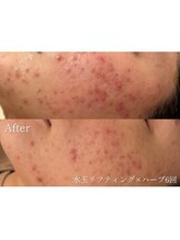 ヴェアリー 広尾(VARY)/ハーブ6回