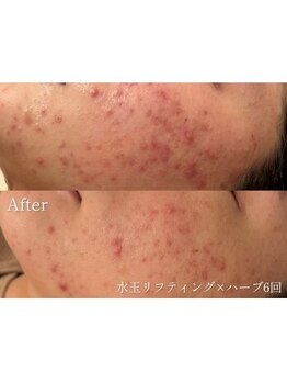 ヴェアリー 広尾(VARY)/ハーブ6回