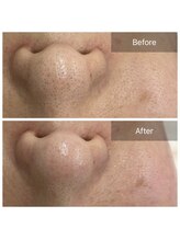 エステティックアウラジパング(Esthetic Aura Zipangu)/毛穴エクストラクション