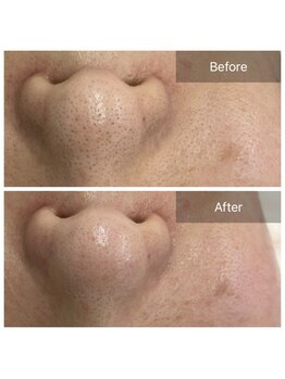 エステティックアウラジパング(Esthetic Aura Zipangu)/毛穴エクストラクション