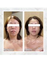 フローフシ∞/【小顔】30代女性症例写真