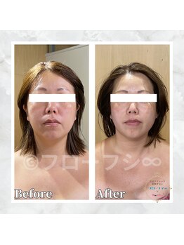 フローフシ∞/【小顔】30代女性症例写真