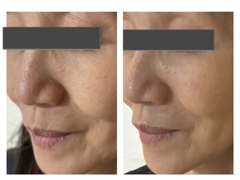 ザ ワン(THE ONE)/【幹細胞マスク】 効果