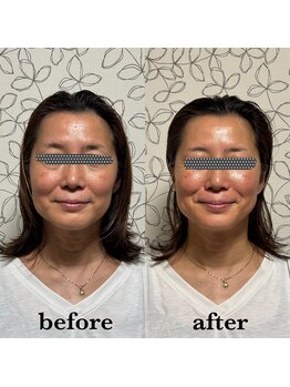 プレシャス(Precious)/肌育改善+ヘッドスパ