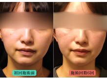 やなけん 亀戸店の雰囲気(シュッとしたV字の輪郭と小顔を実感してみませんか?)