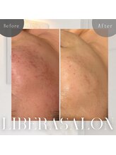 リベラサロン(LIBERA SALON)/ニキビ&トーンアップ☆