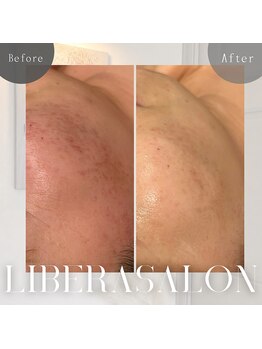 リベラサロン(LIBERA SALON)/ニキビ&トーンアップ☆