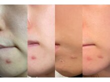 ルーナジェーナ(Luna llena)/肌質改善／肌ファスティング