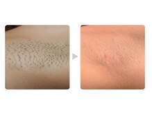 カレン 沖縄小禄店/脱毛結果４　脇