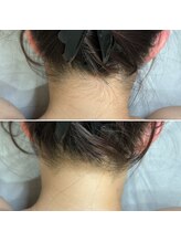 インベスト(INVEST)/うなじ脱毛