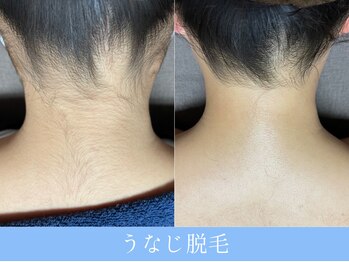 オーシャンブルー 大分店(OCEAN BLUE)/うなじ脱毛