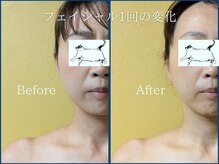 ボンボン(BONBON)/施術　小顔フェイシャル