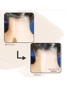 ヴィセル(VISEL)/うなじ脱毛