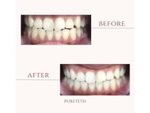 ピュアティス(PURETETH)/30代男性　before &after