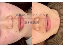 ライフサロン 天神(Life Salon)/肌質改善