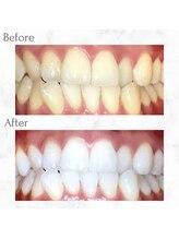 エクシアホワイトニング 天神店/ホワイトニングビフォーアフター