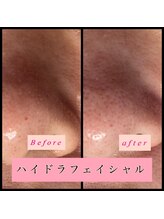 ティアメディカル(Tia Medical)/ハイドラフェイシャル