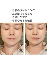 リムビューティー 自由が丘(RymBeauty)/水光リフトはこんな方にも