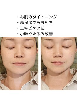 リムビューティー 自由が丘(RymBeauty)/水光リフトはこんな方にも