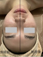 エメ 心斎橋(Aimer)/小顔・リフトアップ