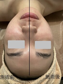 エメ 心斎橋(Aimer)/小顔・リフトアップ