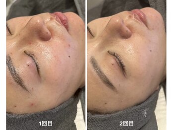 ベル 本八幡(Belle)/毛穴洗浄/ハーブピーリング