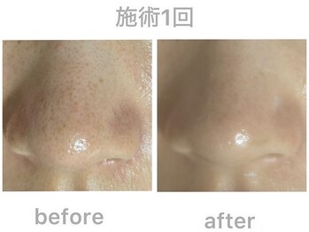 ホワイト ターコイズ/鼻と頬の毛穴＆黒ずみ