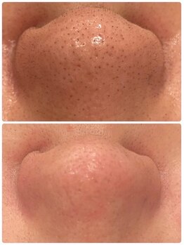 ラナ(LANA)/ハイドラ毛穴洗浄☆BeforeAfter