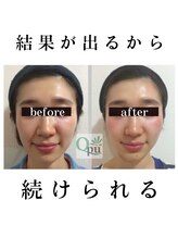 キュープ 松戸店(Qpu)/小顔頭蓋骨矯正