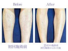 ツルツル美肌脱毛/【メンズ脱毛】ひざ下脱毛