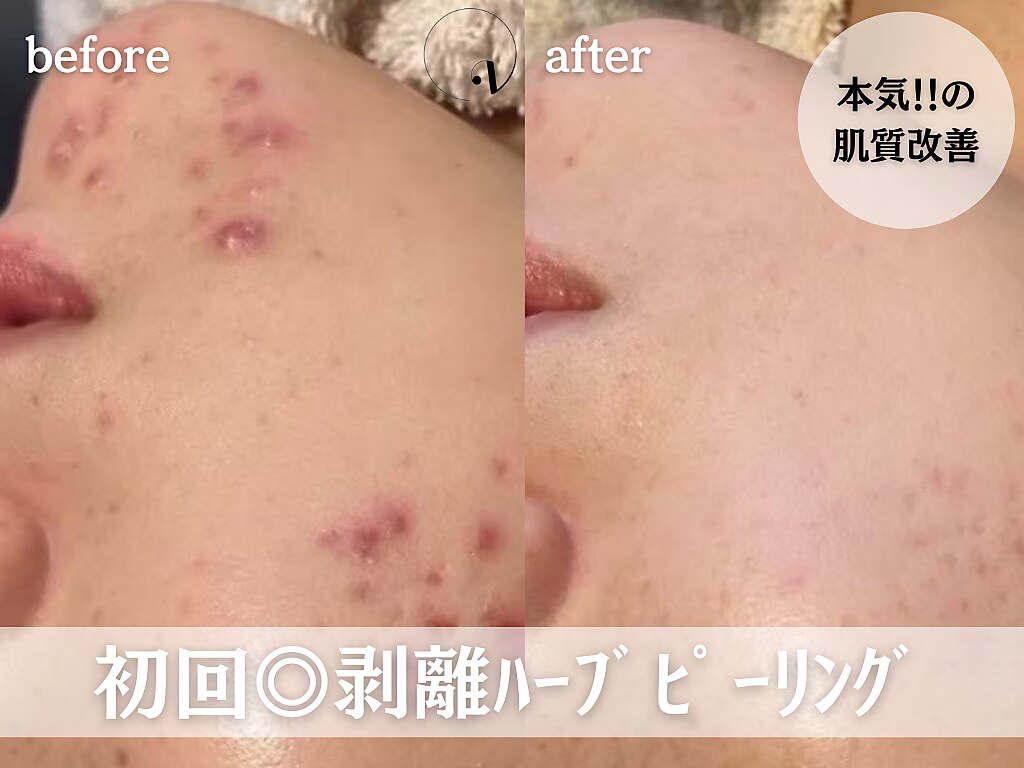 ハーブピーリングbeauty page1 ハーブピーリングパック 150g: コスメ＆ビューティー | ロフト