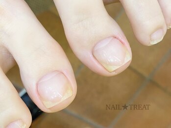 ネイルトリート 茨木駅前店(NAIL TREAT)の写真/巻き爪ケアも◎ハンドケアやフットケアもジェルにオプション追加出来ます～☆うるおった美爪へ導きます♪